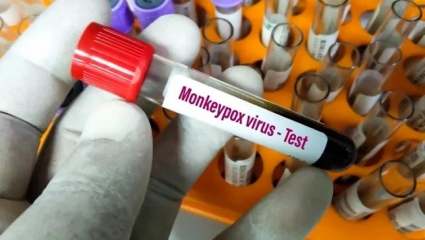 Παγώνη για ευλογιά πιθήκων: Κρατάει 4 εβδομάδες -Χρειάζεται καραντίνα